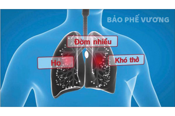 Ho khan, ho đờm là các triệu chứng thường gặp của viêm phế quản