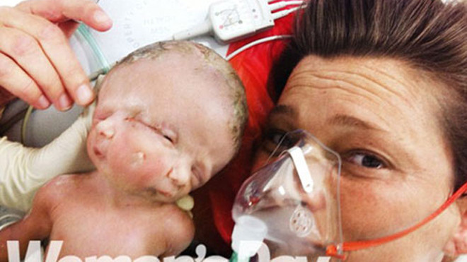 Bé gái có 2 khuôn mặt, 2 bộ não