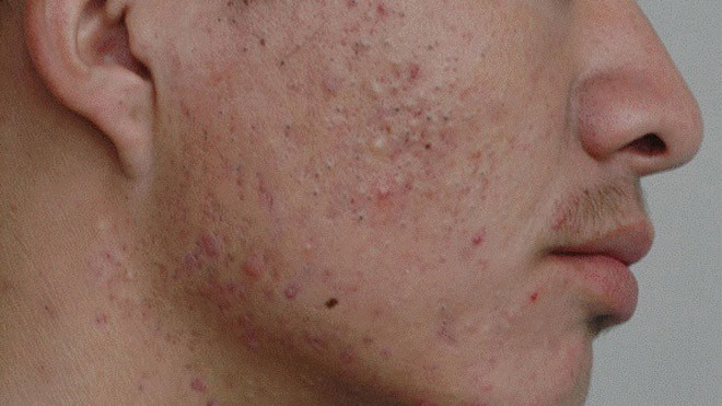 Điều trị mụn trứng cá cần liệu trình lâu dài.