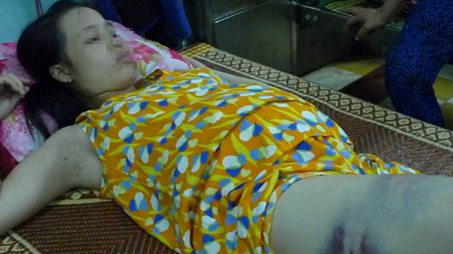 Dù đang mang thai nhưng chị H vẫn bị người chồng đánh đập.