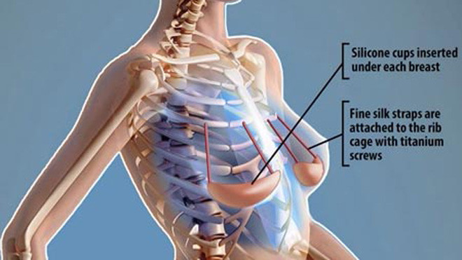 Áo nâng ngực dưới da cấu tạo gồm một quả áo ngực bằng silicon loại tốt, ở dạng rắn đặt dưới mô vú và các dây đeo bằng lụa gắn cố định vào xương sườn của bệnh nhân để nâng đỡ bầu ngực. Ảnh: Daily Mail