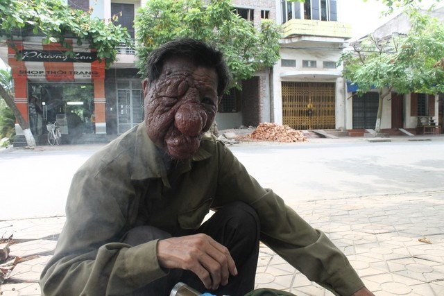 Ông Đỗ Văn Luyện và khối u quái ác trên mặt.