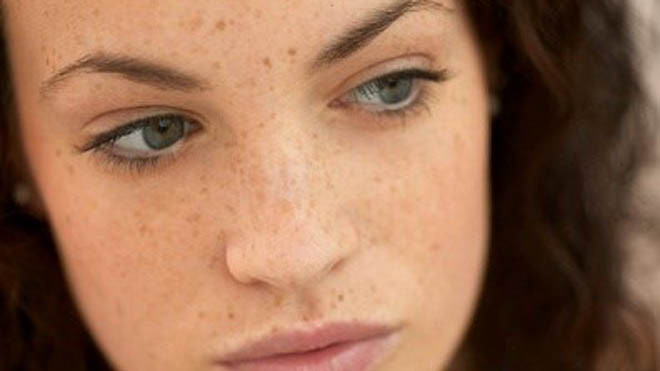 Tàn nhang là vết sạm nhỏ ngoài da. Hình minh họa.