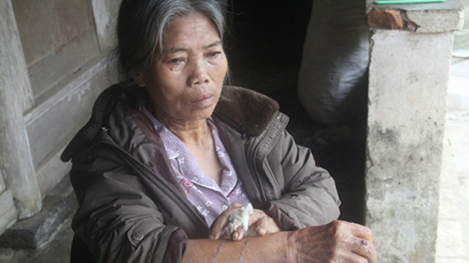 Bà Vỹ mang nhiều thương tích trong hai phút đối mặt với tên cướp. Ảnh: Thiên Ân.