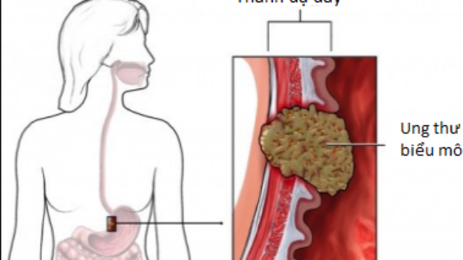 Ung thư dạ dày: Ai dễ mắc?