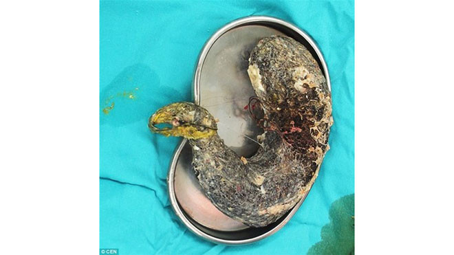  Búi tóc khổng lồ lấy ra từ dạ dày bé gái