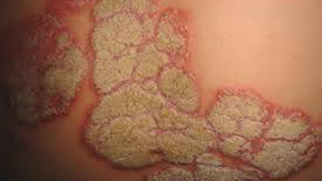 Thương tổn trên da ở bệnh nhân vẩy nến