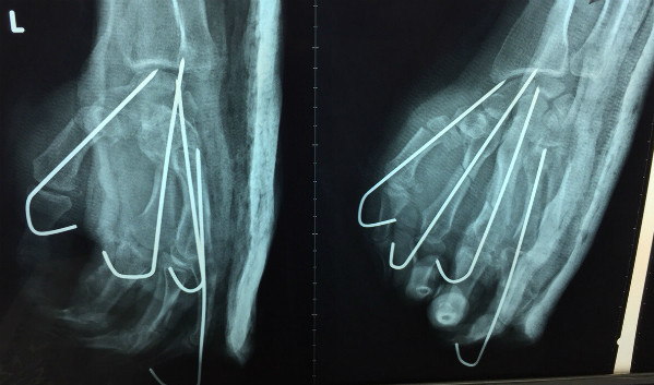 Ảnh chụp X-quang sau mổ của bệnh nhân. Ảnh bệnh viện cung cấp.