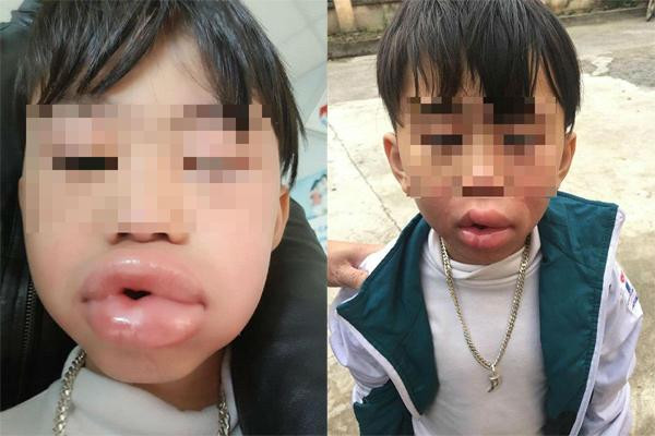 Hình ảnh cháu bé bị sưng môi sau khi ăn kẹo. Ảnh: GĐCC.