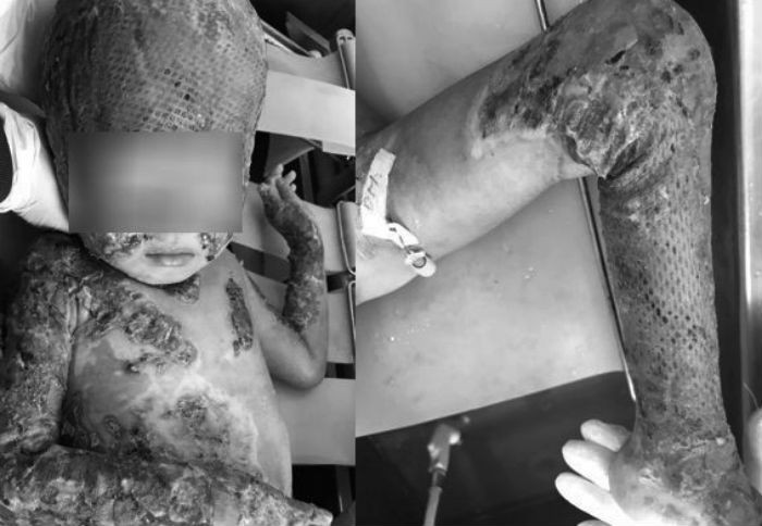 Bệnh nhi sau khi được ghép da từ người cha