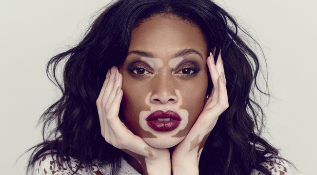 Hội chứng khiến người bệnh sở hữu vẻ ngoài kỳ dị có 1 không 2