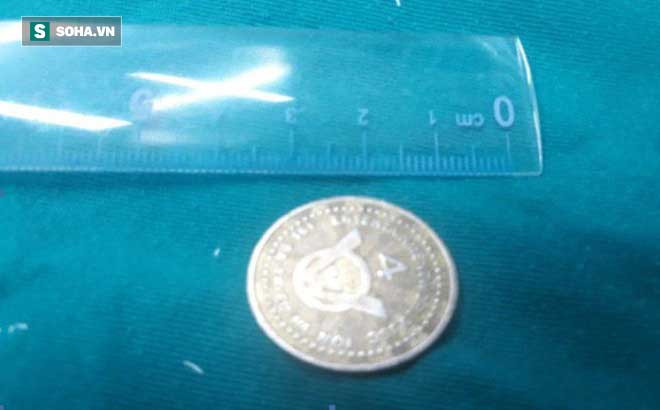 Bé trai 7 tuổi phải nhập viện cấp cứu vì đồng xu mắc ngang cổ