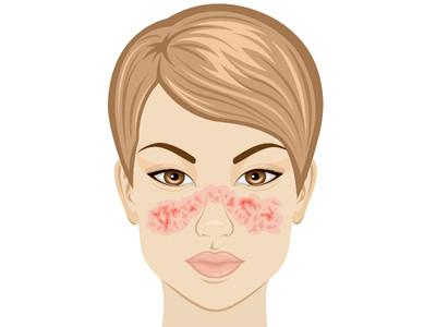 Vết phát ban hình con bướm cảnh báo nguy cơ mắc bệnh lupus. Ảnh: Pinterest.