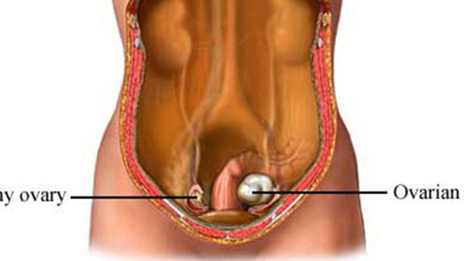 Minh họa so sánh buồng trứng bị ung thư (phải) và buồng trứng lànhẢnh: uvahealth.com
