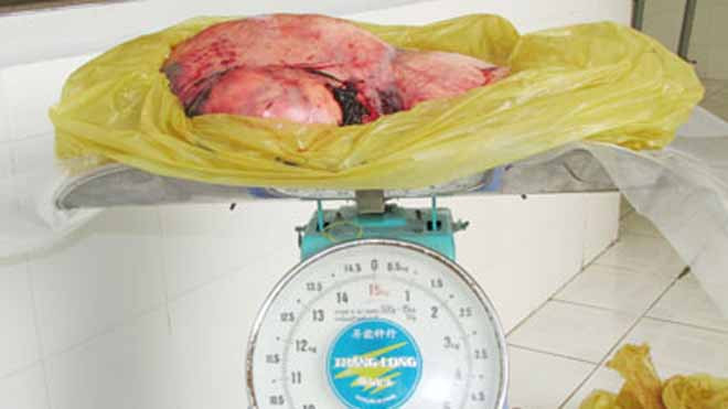 Ngày 19-2, khoa sản tiếp nhận bà cụ Trần Thị Nghệ (78 tuổi, ngụ tại ấp Thạnh An, xã Thạnh Quới, huyện Mỹ Xuyên, tỉnh Sóc Trăng) nhập viện trong tình trạng khối u bị phình chướng to ở bụng, nôn ói,khó thở. Tuy nhiên do sức khỏe bà cụ quá yếu, ăn uống không