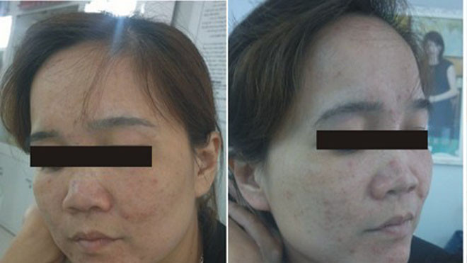 Chị Hoàng Thị D. trị nám, làm trắng da bằng mủ trôm gây nên bệnh viêm da cấp tính
