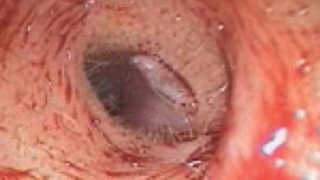 Ấu trùng ruồi giấm “gặm thủng” ống tai