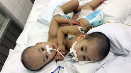 Hai Bé Long-Phụng khi chưa được tách rời.