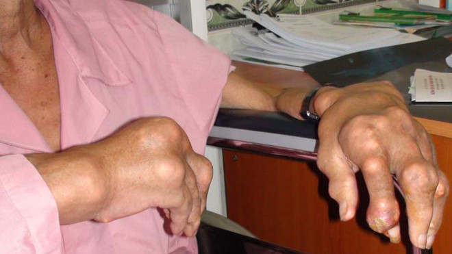 Tinh thể urat thường lắng đọng tại khớp bàn tay, cổ tay,…