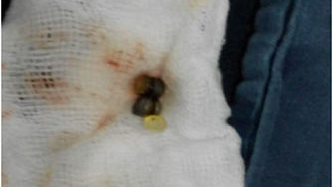  Dị vật được lấy ra là 4 hạt kim loại từ tính