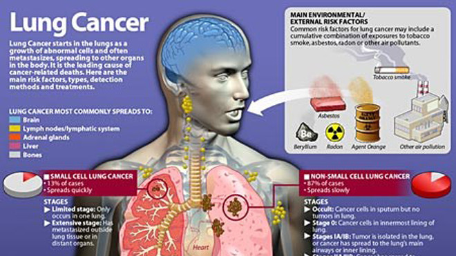 Thuốc lá – sát thủ số 1 gây ung thư phổi, lấy đi sinh mạng 1,8 triệu người mỗi năm