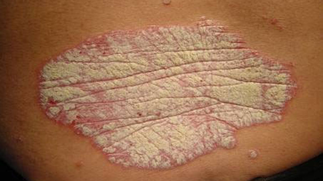 Mảng đỏ với vẩy trắng phủ lên ở bệnh nhân vẩy nến