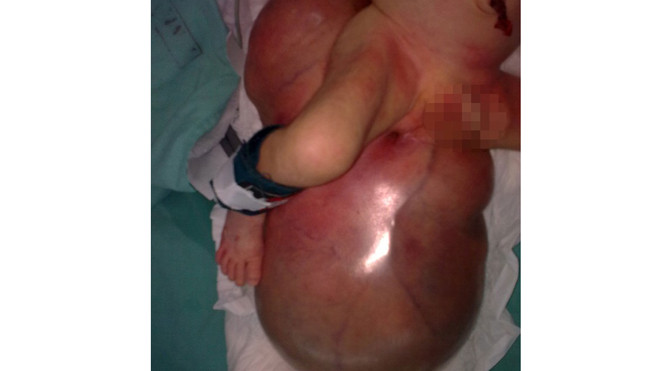 U quái khổng lồ vùng cùng cụt ở trẻ sơ sinh 5 ngày tuổi