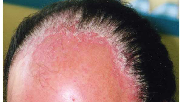 Vẩy nến da đầu