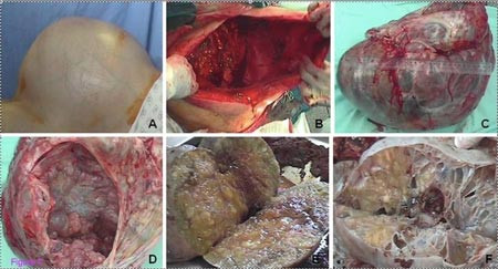 Cận cảnh quá trình mổ lấy khối u buồng trứng khổng lồ, nặng gần 40kg cho bệnh nhân Brazil. Ảnh: Live Science