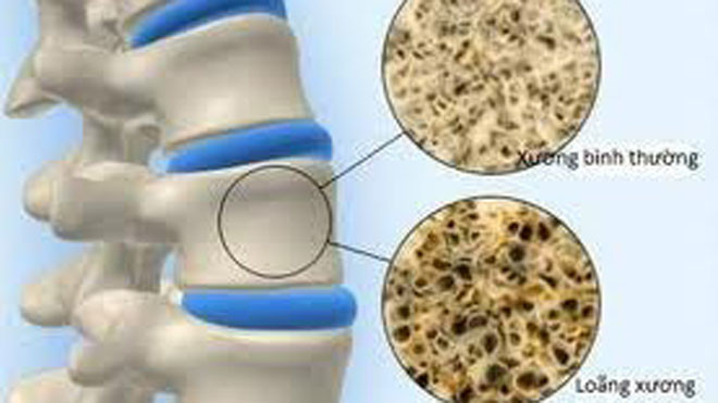 Canxi là một yếu tố cần thiết cho xương, thiếu canxi gây ảnh hưởng nặng nề lên xương.