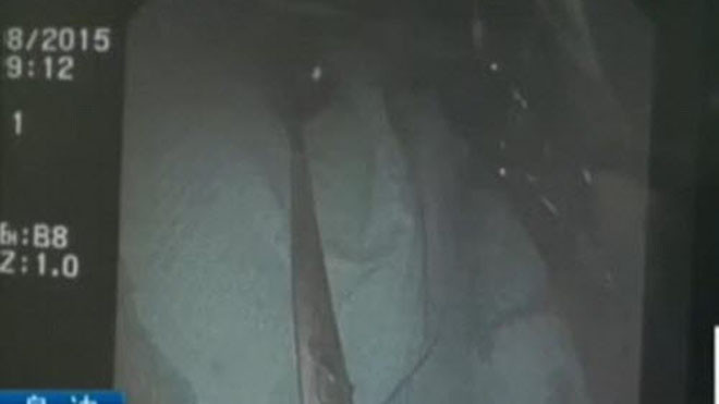 Chiếc muỗng mà người phụ nữ nuốt phải