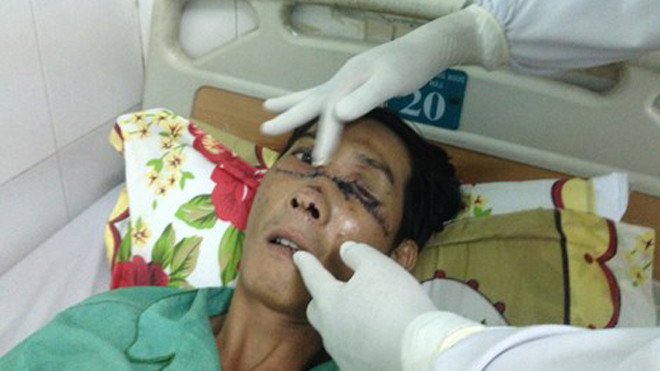 Gãy đôi xương mặt, mất mắt trái vì nổ bánh 'xe rùa'