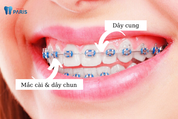 Niềng răng mắc cài kim loại thường