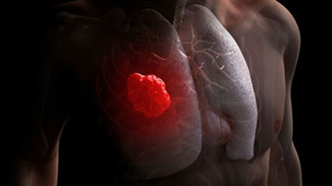 Nguyên nhân gây ung thư phổi