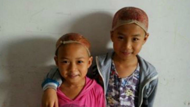 Hai em bé hiến da đầu cho cha. Ảnh: CCTV