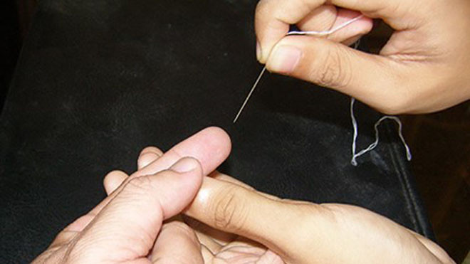 Chưa có chứng cứ khoa học xác định tính hiệu quả của việc châm kim vào ngón tay để trị đột quỵ. Ảnh: TRẦN NGỌC