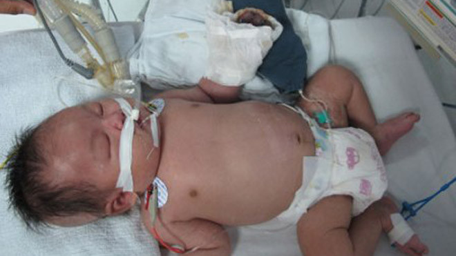 Bé Khuất Tiến Minh đã tử vong tại Bệnh viện Nhi Trung ương do nhiễm trùng huyết nặng