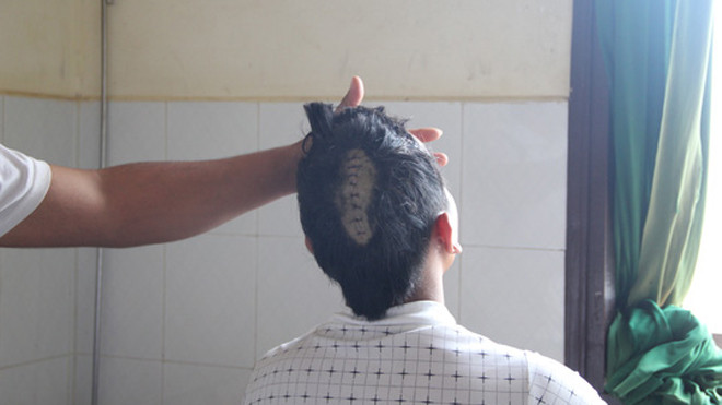 K' Đích bị chém nứt sọ và gãy 2 ngón tay trái đang điều trị tại Bệnh viện Đa Khoa II Bảo Lộc (Lâm Đồng).