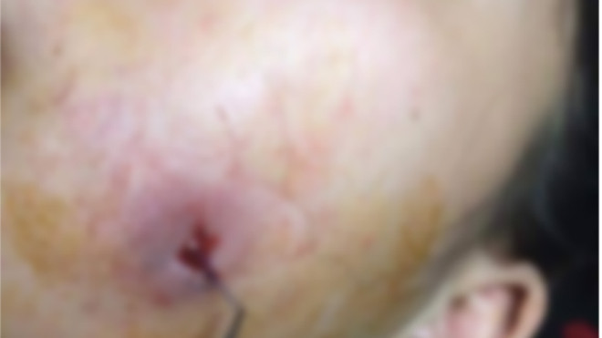 Trào lưu phẫu thuật tạo má lúm có thể khiến khuôn mặt bị hủy hoại