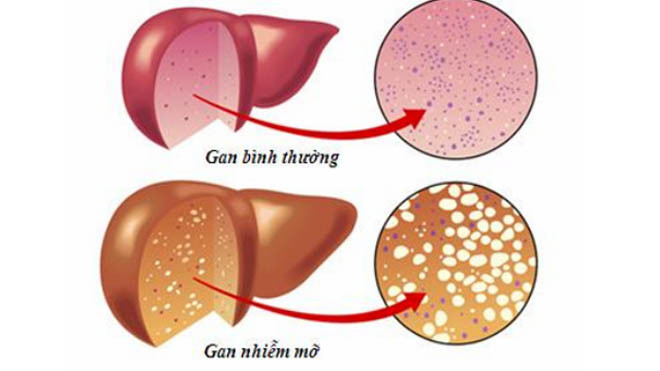 So sánh gan khỏe và gan nhiễm mỡ.
