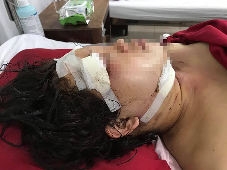 Chị M đang được cấp cứu tại bv Trung ương Huế