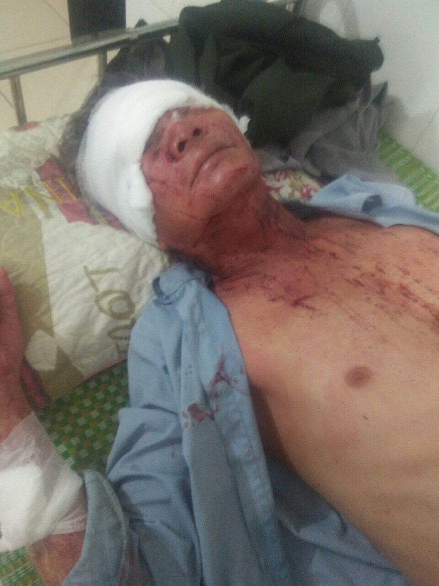 Ông Tùng đang điều trị tại Bệnh viện đa khoa tỉnh Thanh Hóa 