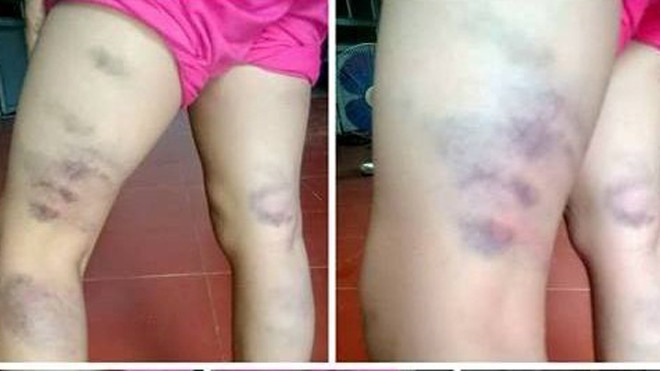 Hình ảnh Thi bị đánh thâm tím được chia sẻ trên mạng xã hội