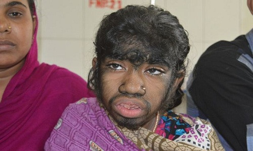 Bithi mắc "hội chứng người sói" khiến cơ thể bị bao phủ hoàn toàn bởi lớp lông đen. Ảnh: Mirror.