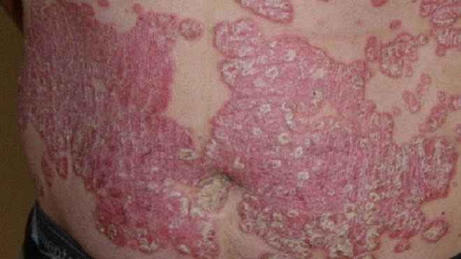 Hình ảnh da bị tổn thương do tác dụng phụ của corticoid