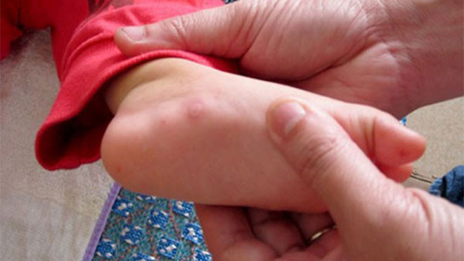 Tay chân miệng là một trong những bệnh trẻ dễ mắc trong mùa hè