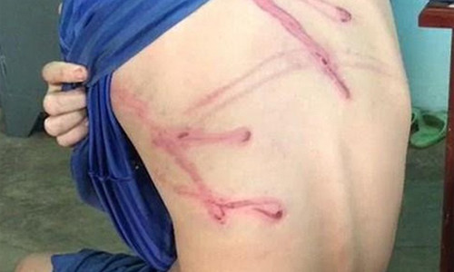 Cháu Phát bị cha dùng dây điện đánh gây thương tích khắp cơ thể.