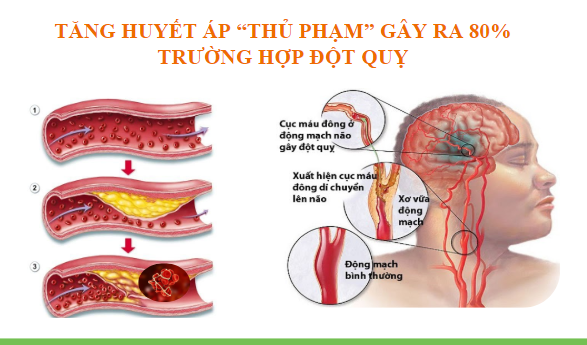  Xu hướng mới trong điều trị tăng huyết áp và phòng ngừa đột quỵ