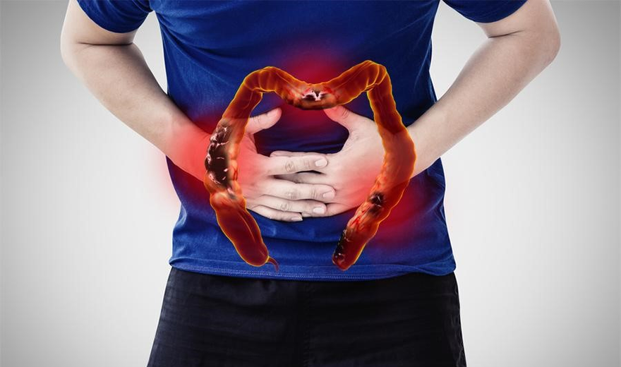 Viêm đại tràng nỗi ám ảnh kinh hoàng