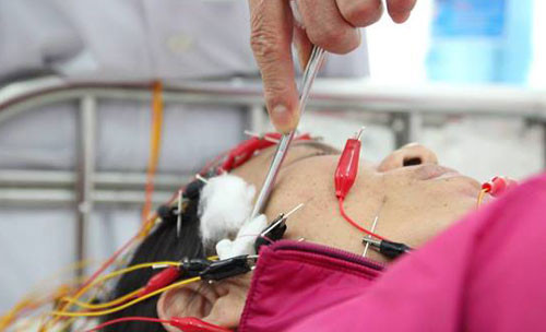 Trời rét đậm khiến nhiều người bị liệt dây thần kinh số 7. Ảnh: L.P.